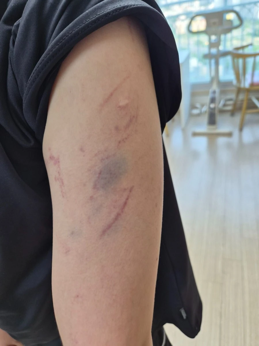 초등학생 아이가 동급생에게 맞고 왔는데 상흔 봐주실 수 있나요? 조언 구합니다